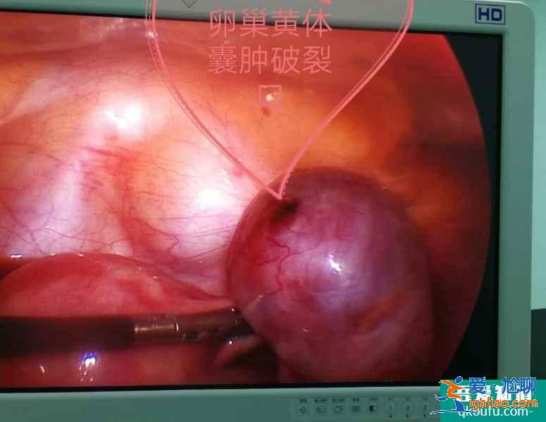 卵泡破裂是怎么回事？卵泡破了没怀孕怎么办？