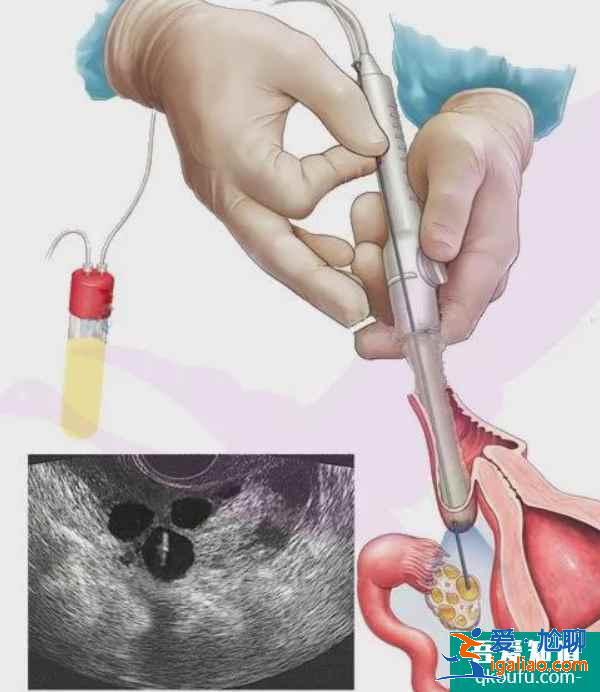 答疑：试管促排取卵后出现腹胀正常吗？如何应对？？