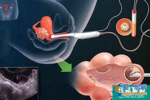 什么原因会导致卵巢过度刺激，试管周期如何避免？？