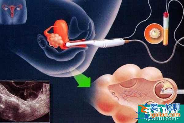 试管婴儿为子宫腺肌症患者保孕护航？