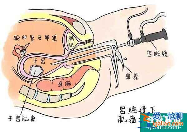 试管婴儿助多发性子宫肌瘤女性赢好孕人生？