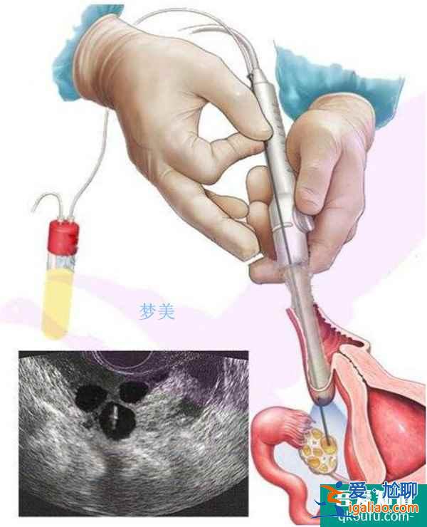 试管专家深度解析：黄体不足对胚胎着床的影响？